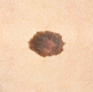 Brown spot on skin